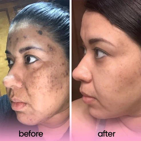 1+1 FREE I Brittyface™ - Turmeric & Kojic Acid Pads