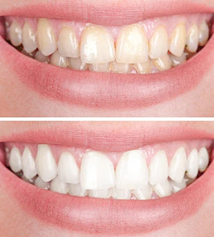 1+1 FREE | Smiley™ - Teeth Whitener