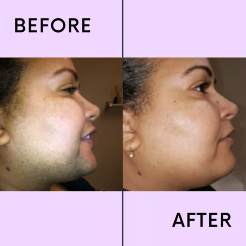 CaedreaEase - Facial Hair Remover - Smooth Skin, No Pain - 1+1 FREE