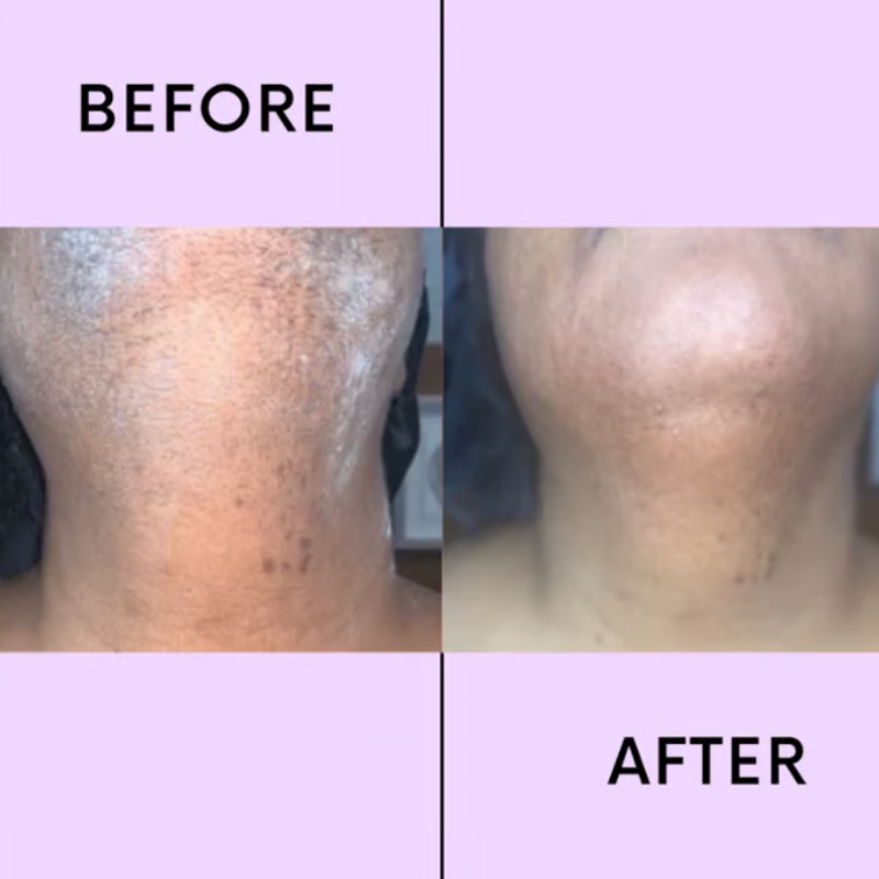 CaedreaEase - Facial Hair Remover - Smooth Skin, No Pain - 1+1 FREE