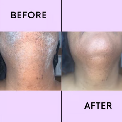 CaedreaEase - Facial Hair Remover - Smooth Skin, No Pain - 1+1 FREE