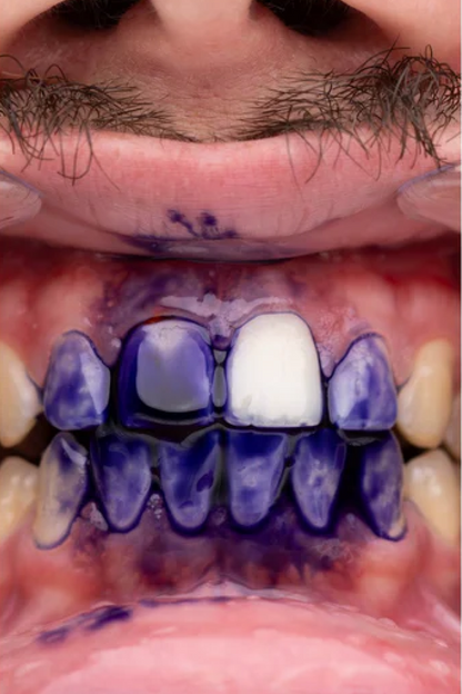 PurpleWhite™ -Whitening Toothpaste