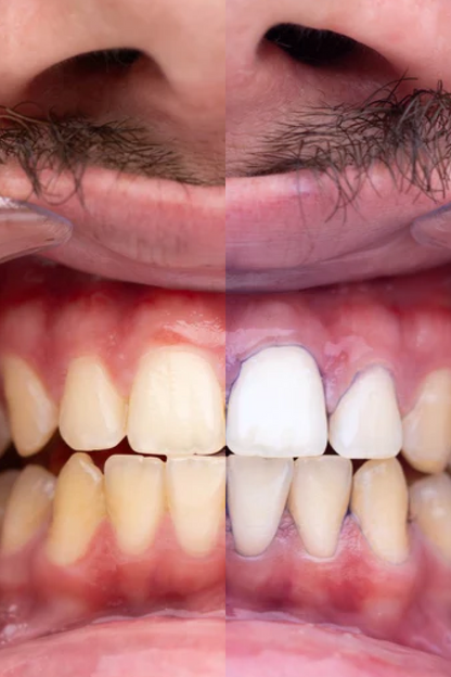 PurpleWhite™ -Whitening Toothpaste