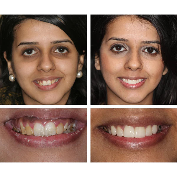 1+1 FREE l OralPlus™ Brighten your smile effortlessly