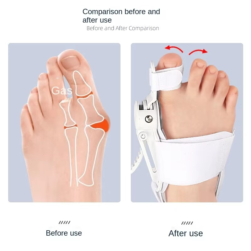 ToeFix™ - Adjustable Toe Alignment